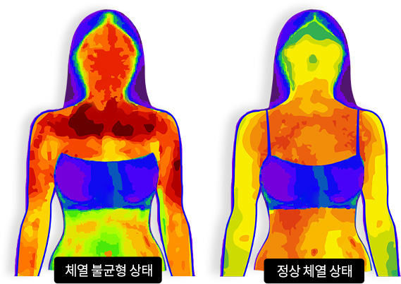 체열 불균형 상태 vs 정상 체열 상태