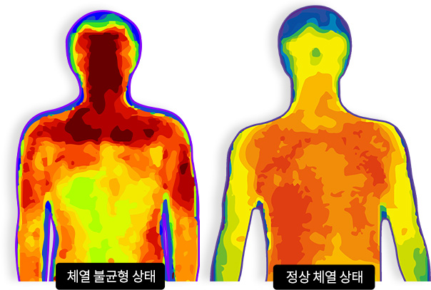 체열 불균형 상태 vs 정상 체열 상태