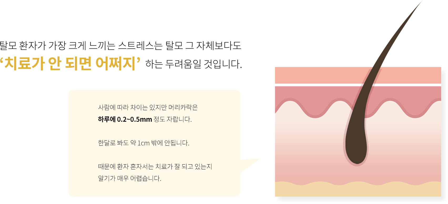 탈모 환자가 가장 크게 느끼는 스트레스는 탈모 그 자체보다도 ‘치료가 안 되면 어쩌지’ 하는 두려움일 것입니다. 사람에 따라 차이는 있지만 머리카락은 하루에 0.2~0.5mm 정도 자랍니다. 한달로 봐도 약 1cm 밖에 안됩니다. 때문에 환자 혼자서는 치료가 잘 되고 있는지 알기가 매우 어렵습니다.