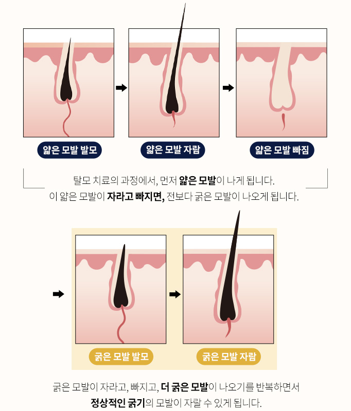 탈모 치료의 과정에서, 먼저 얇은 모발이 나게 됩니다. 이 얇은 모발이 자라고 빠지면, 전보다 굵은 모발이 나오게 됩니다. 굵은 모발이 자라고, 빠지고, 더 굵은 모발이 나오기를 반복하면서 정상적인 굵기의 모발이 자랄 수 있게 됩니다.